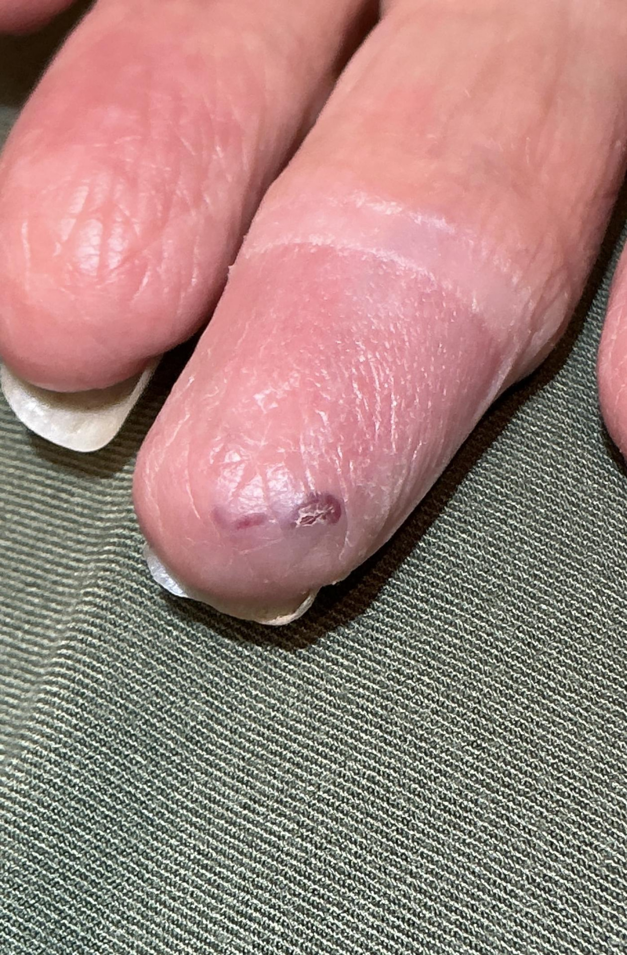 Spider Vein & Hemangioma — Baseline
