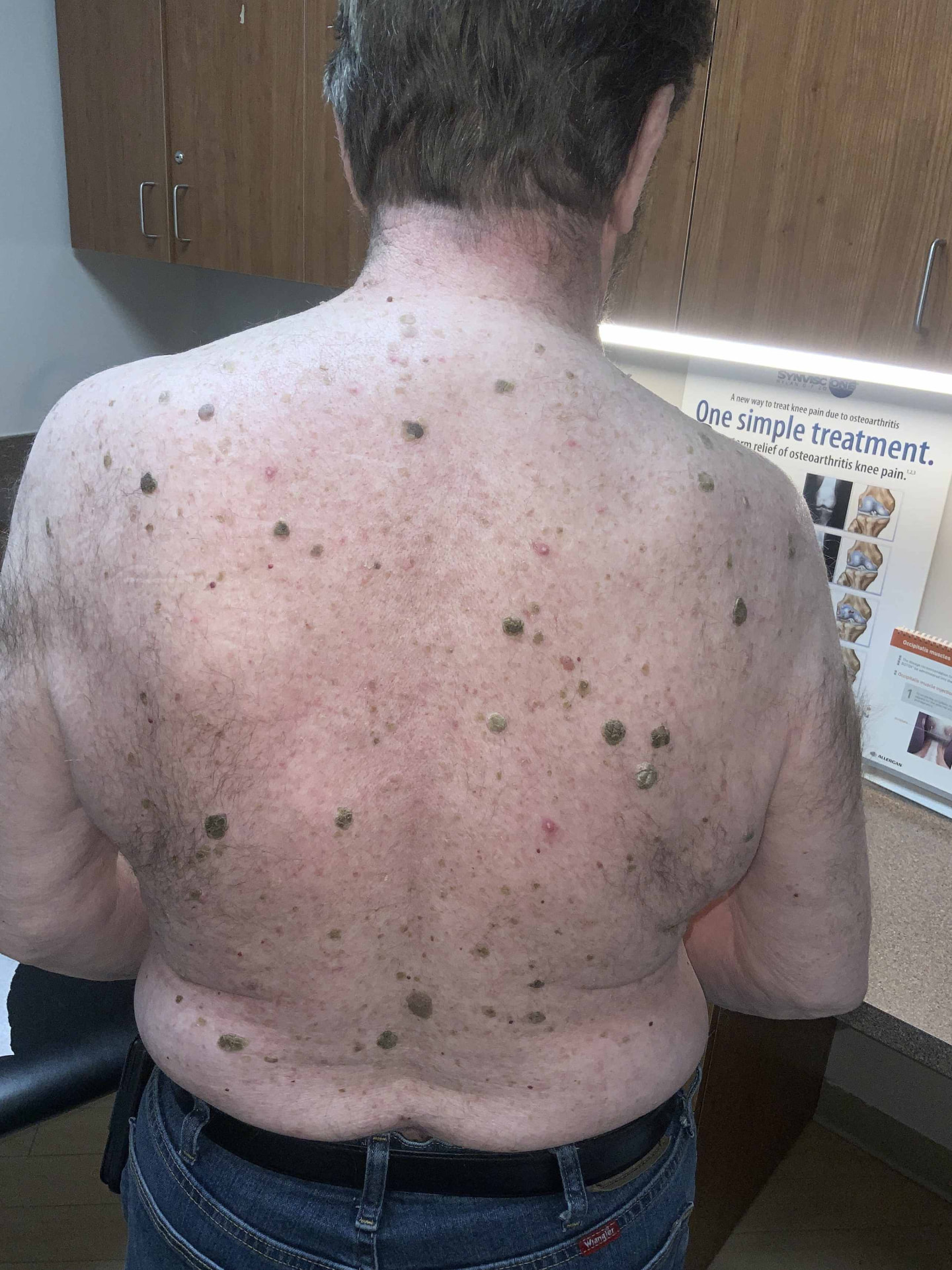 Seborrheic Keratosis & Sunspot Removal — Baseline.