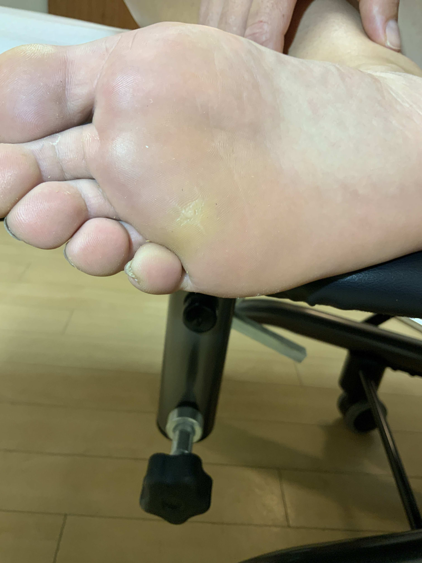 Wart Removal — 4 months after surgical removal