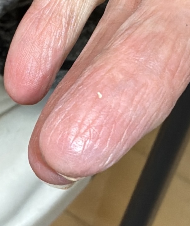 Spider Vein & Hemangioma — 2 months after electrocautery of hemangiomas on finger tip