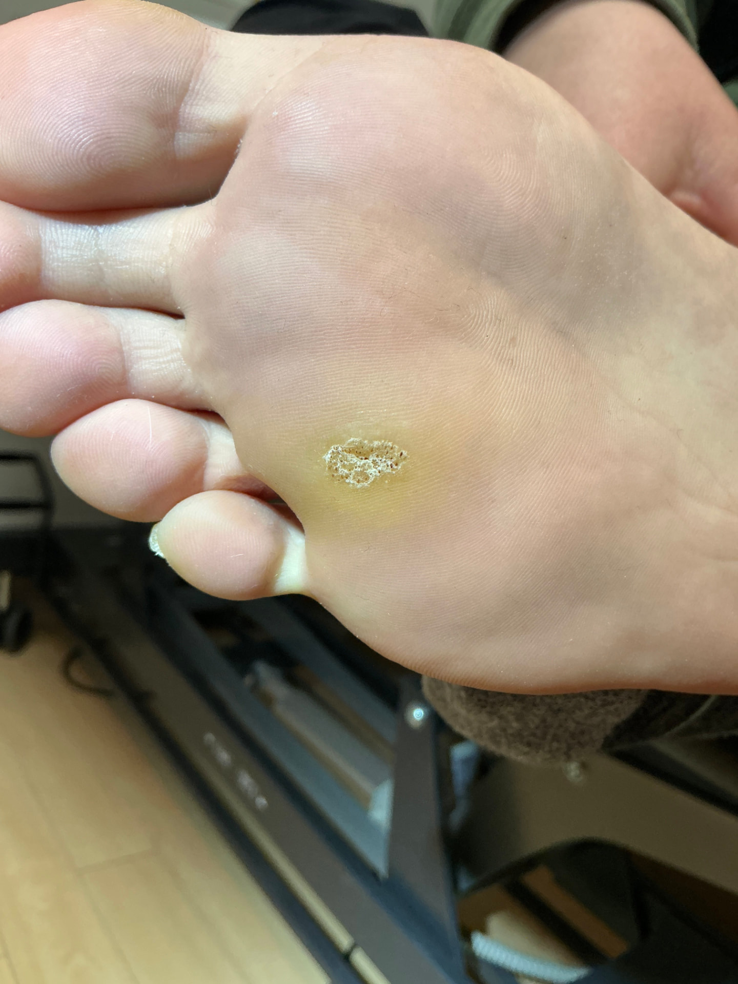 Wart Removal — Baseline