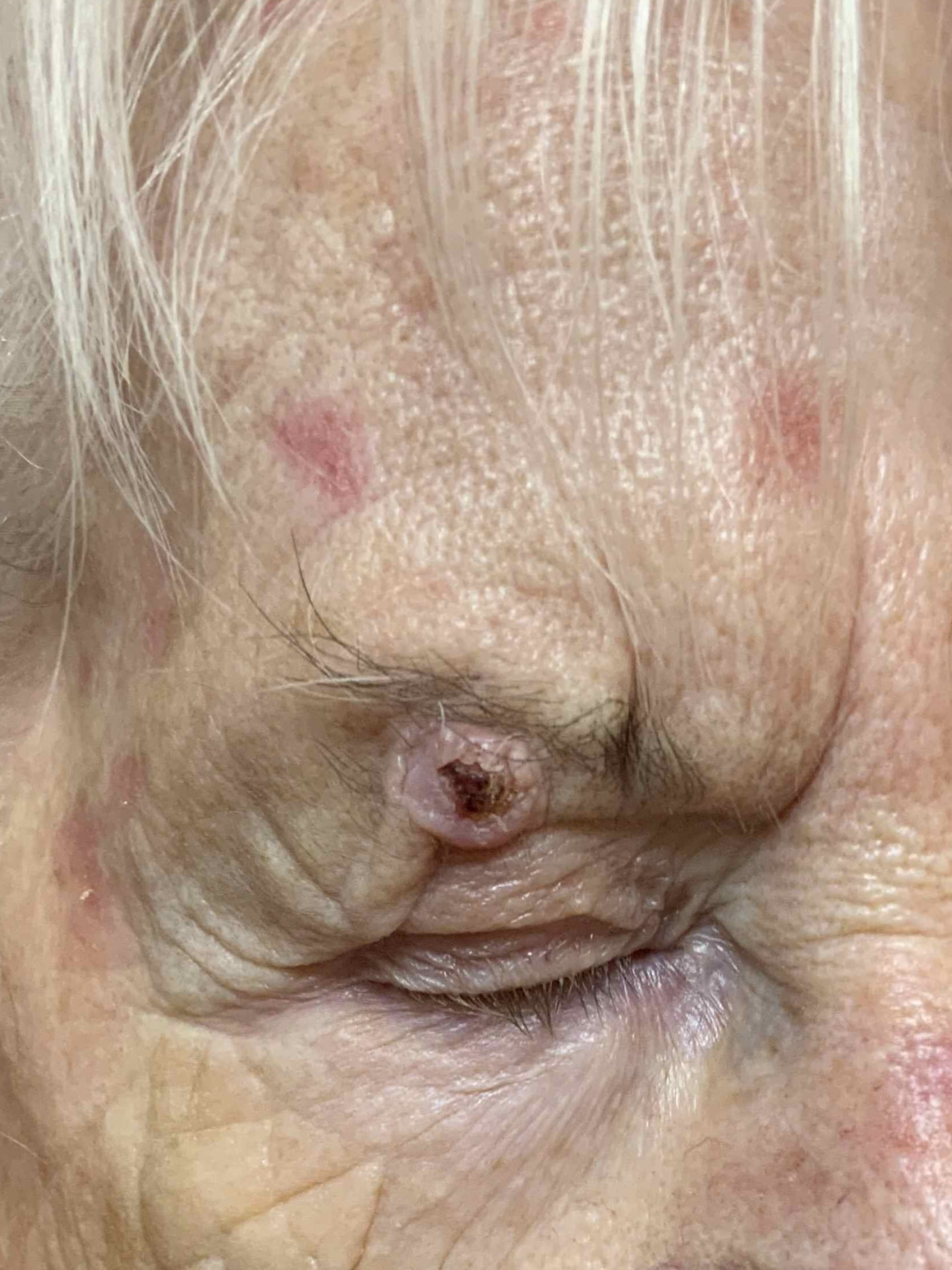 Expert Mole Removal — Baseline - squamous cell carcinoma in eyebrow.