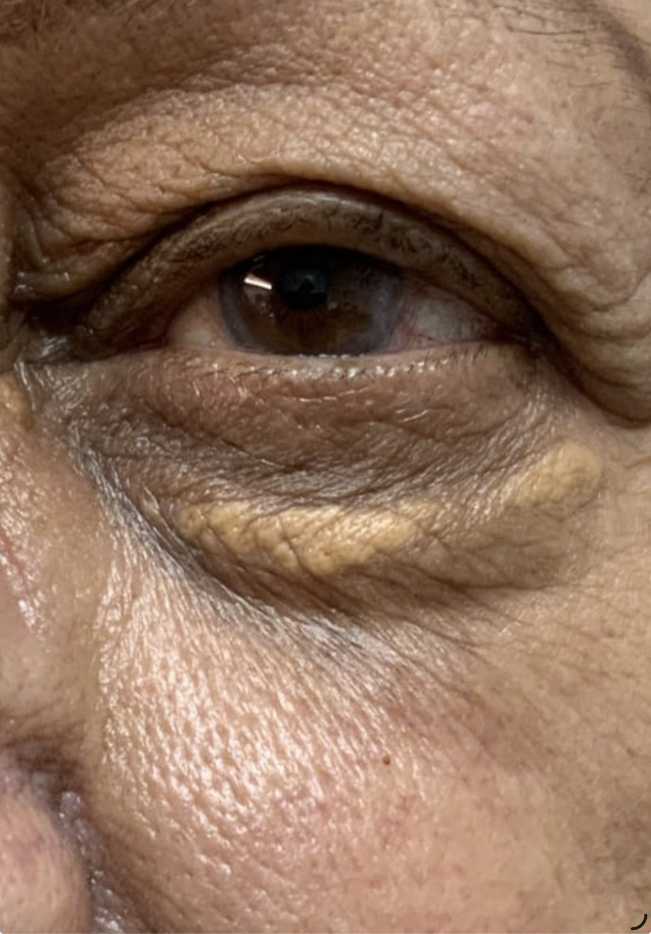 Baseline xanthelasma in patient with type 5 skin.