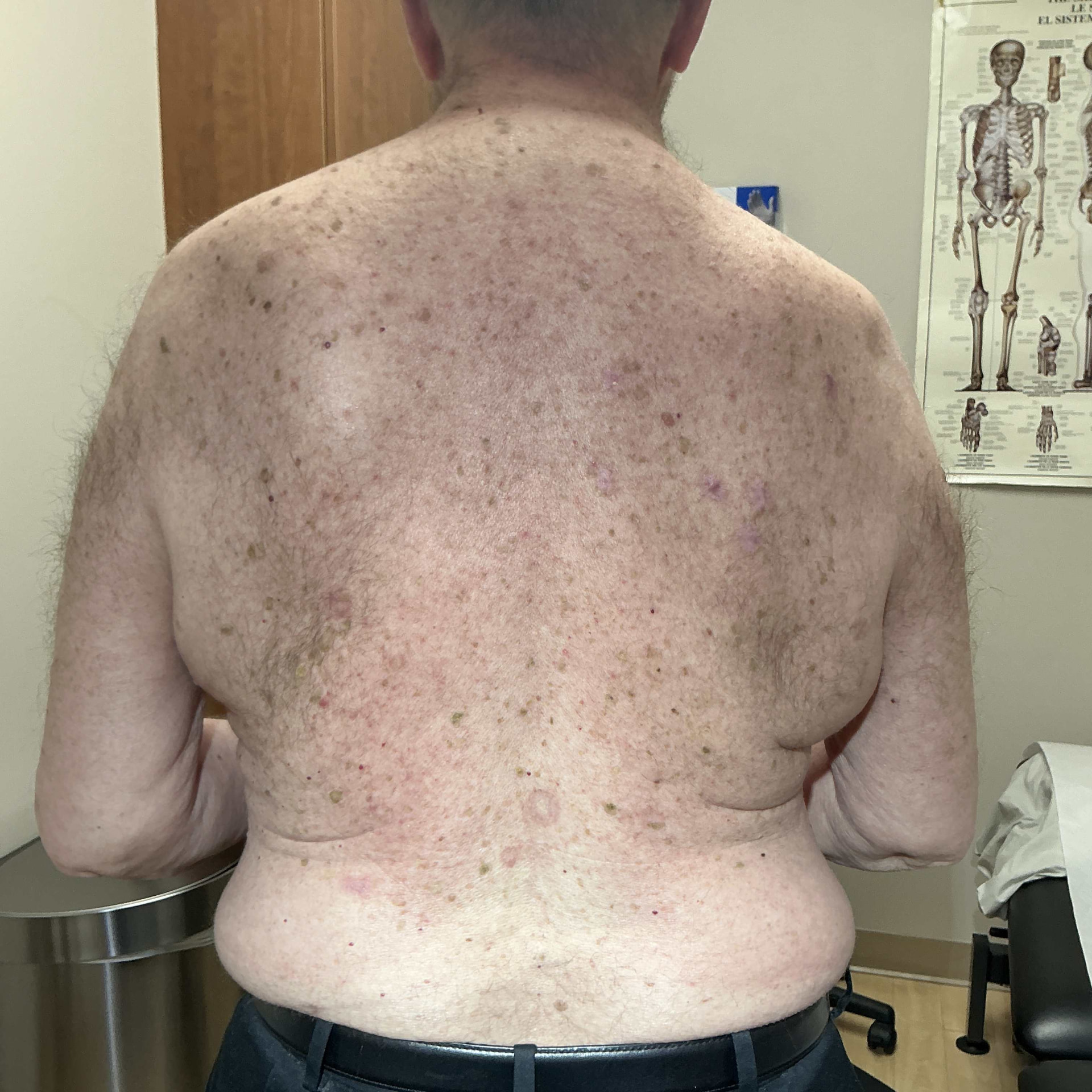 Seborrheic Keratosis & Sunspot Removal — 6 months after surgical shave of seborrheic keratosis lesions.