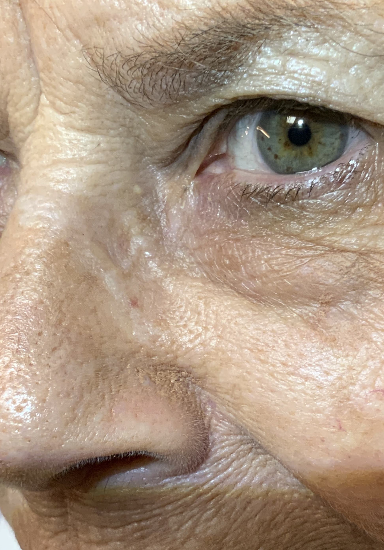 Expert Mole Removal — 2 months after surgical removal of Milia