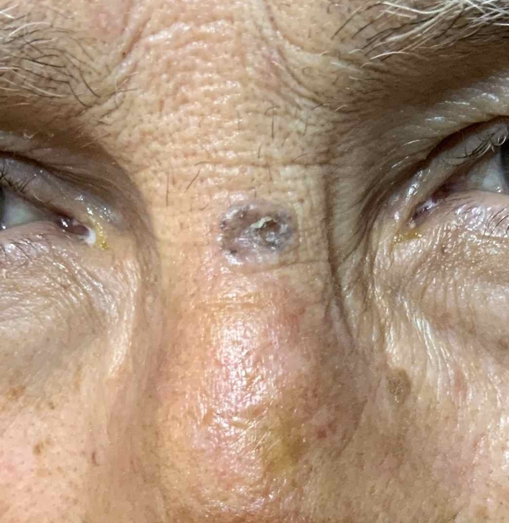 Expert Mole Removal — Baseline - basal cell carcinoma on bridge of nose.