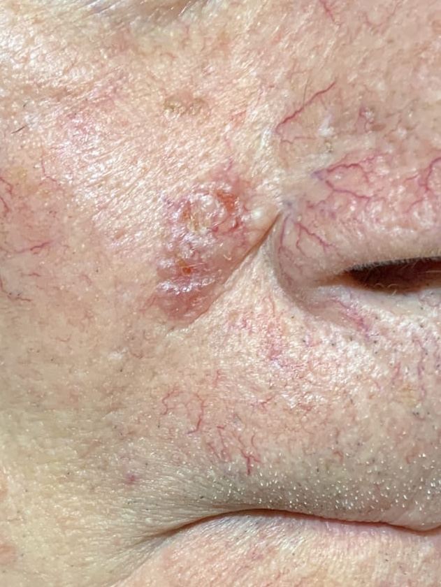Expert Mole Removal — Baseline - basal cell carcinoma on right cheek.