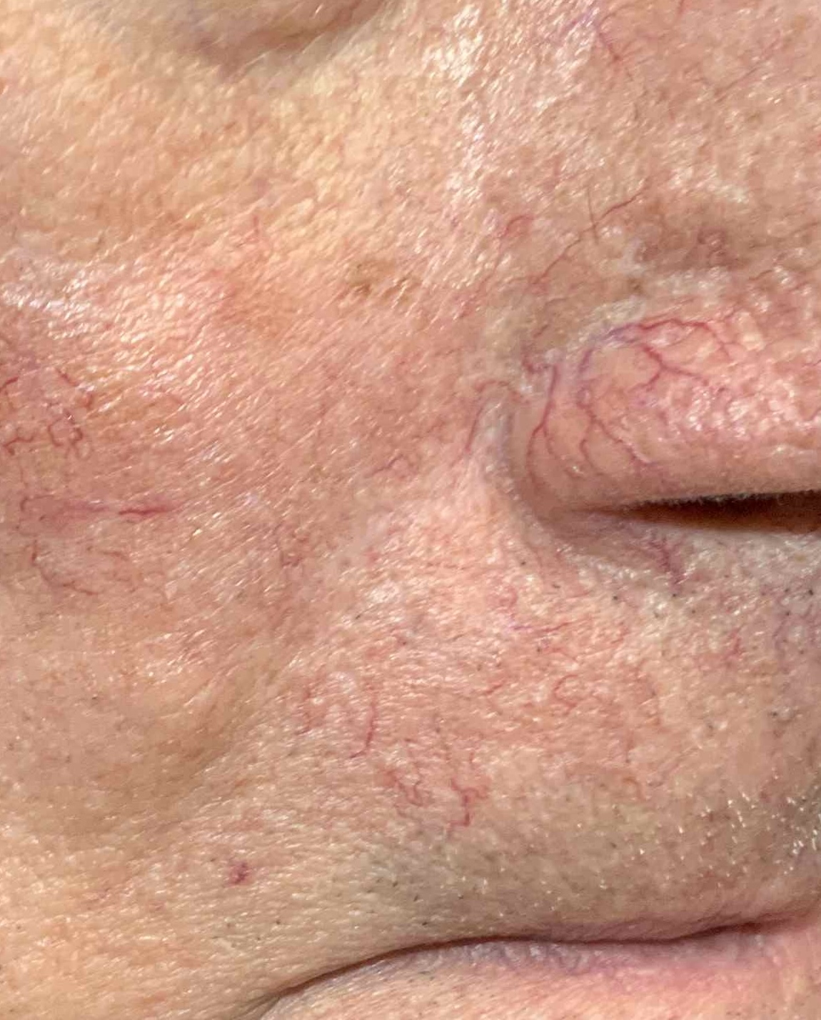 Expert Mole Removal — Six months after surgical excision of Basal cell carcinoma.