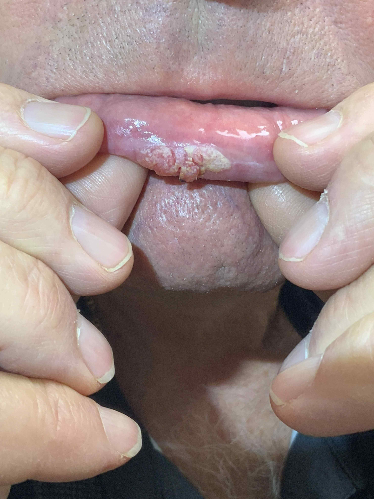 Expert Mole Removal — Baseline - skin cancer lesion lower lip.