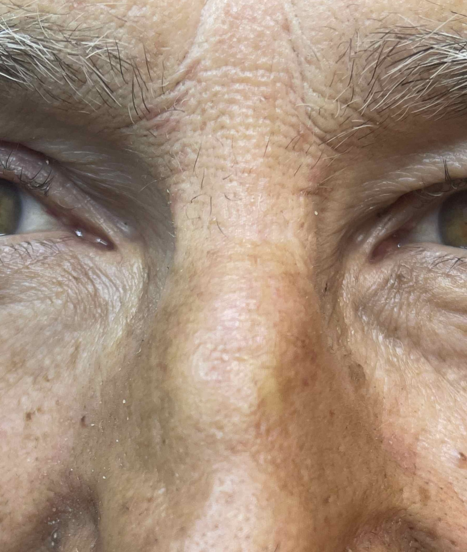 Expert Mole Removal — Six months after surgical removal of basal cell carcinoma.