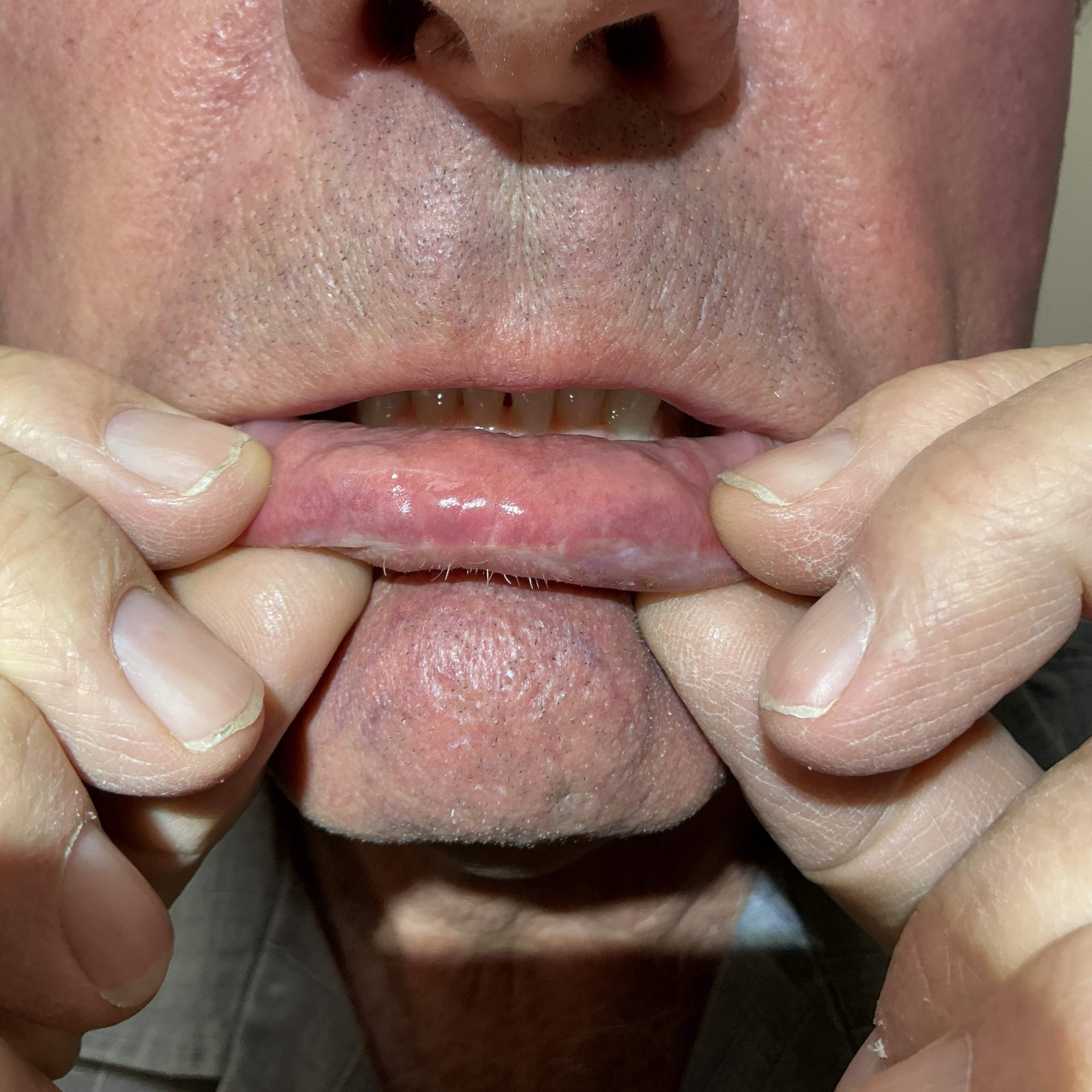 Expert Mole Removal — 5 weeks after surgical removal