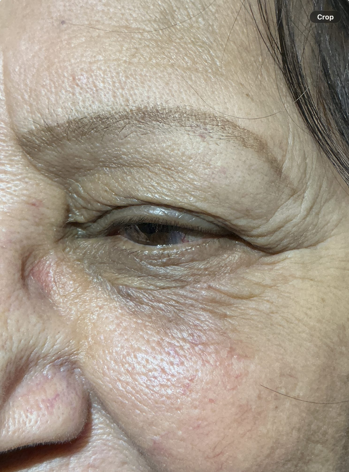 3 months after surgical removal.