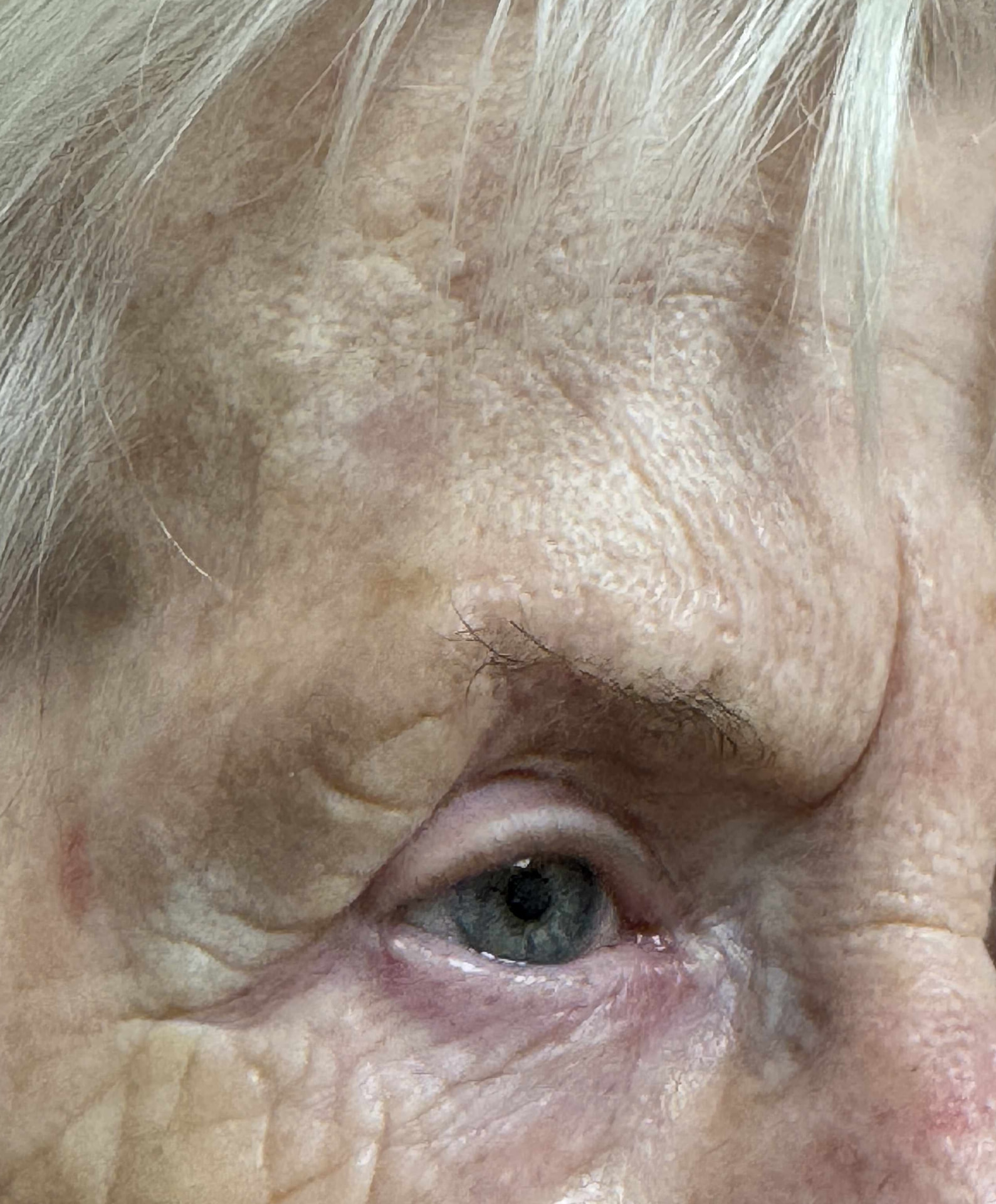 Expert Mole Removal — 6 months after surgical removal of squamous cell carcinoma from eyebrow.