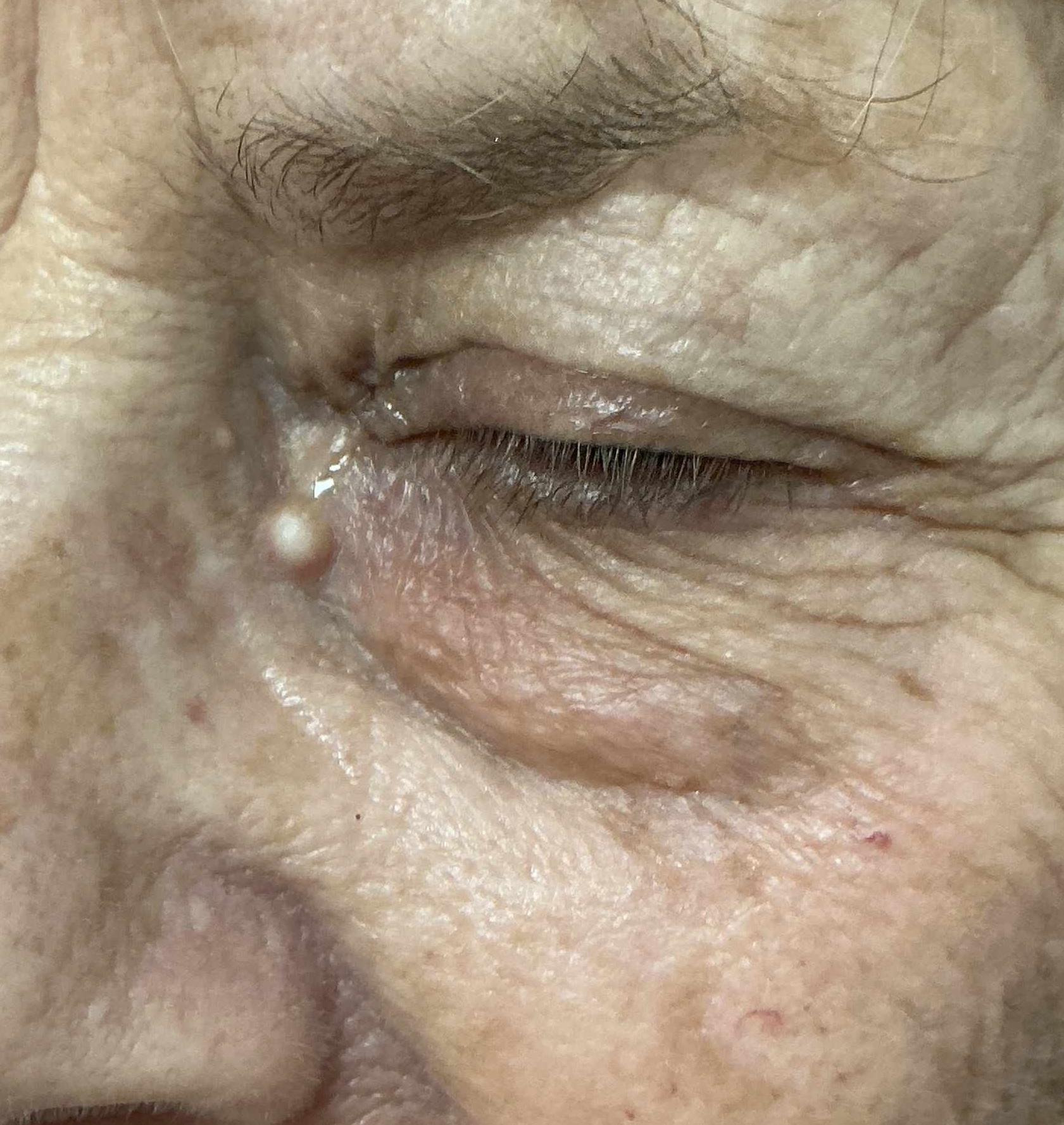 Expert Mole Removal — Left cheek milia cyst - baseline.