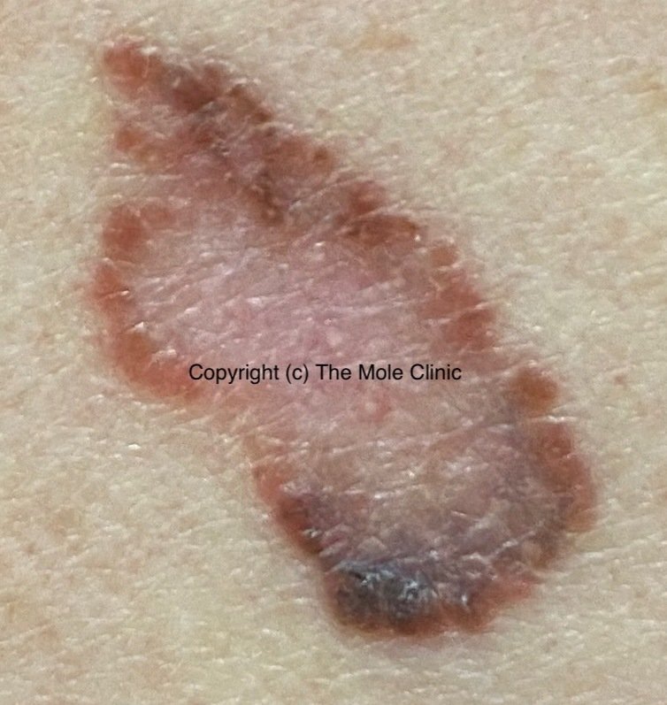 Asymmetry — example of a suspicious mole