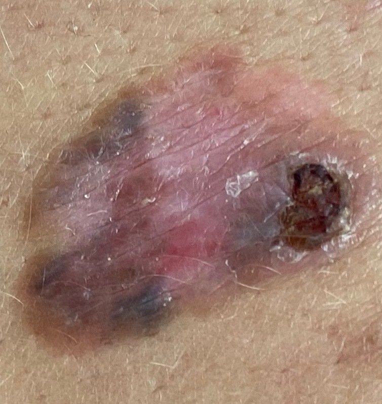 Border — example of a suspicious mole