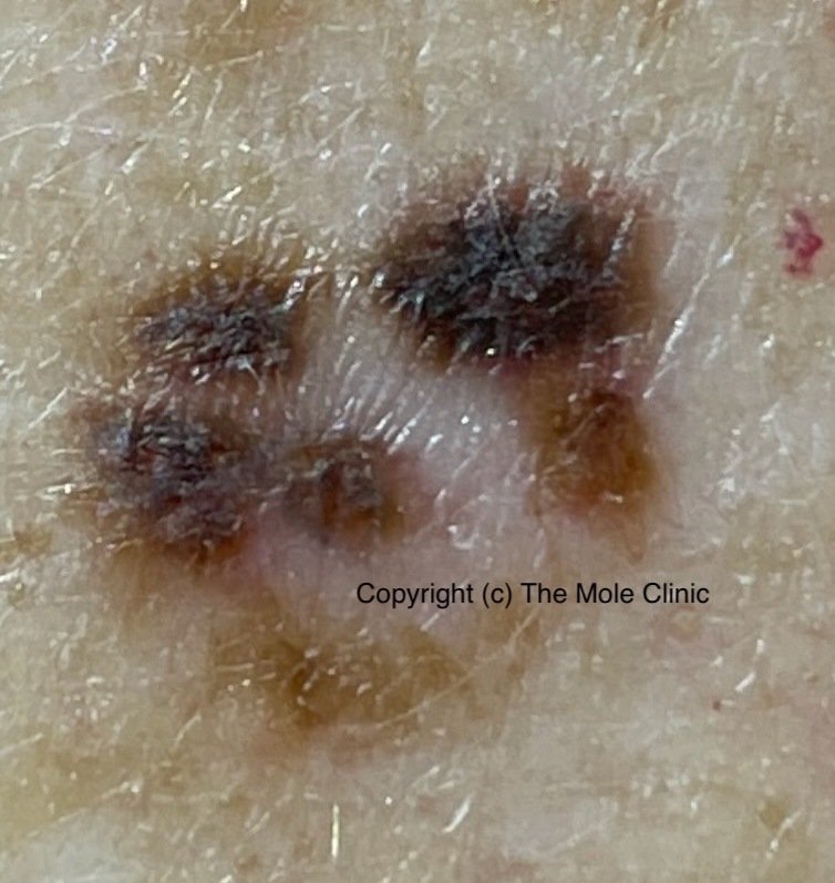 Color — example of a suspicious mole