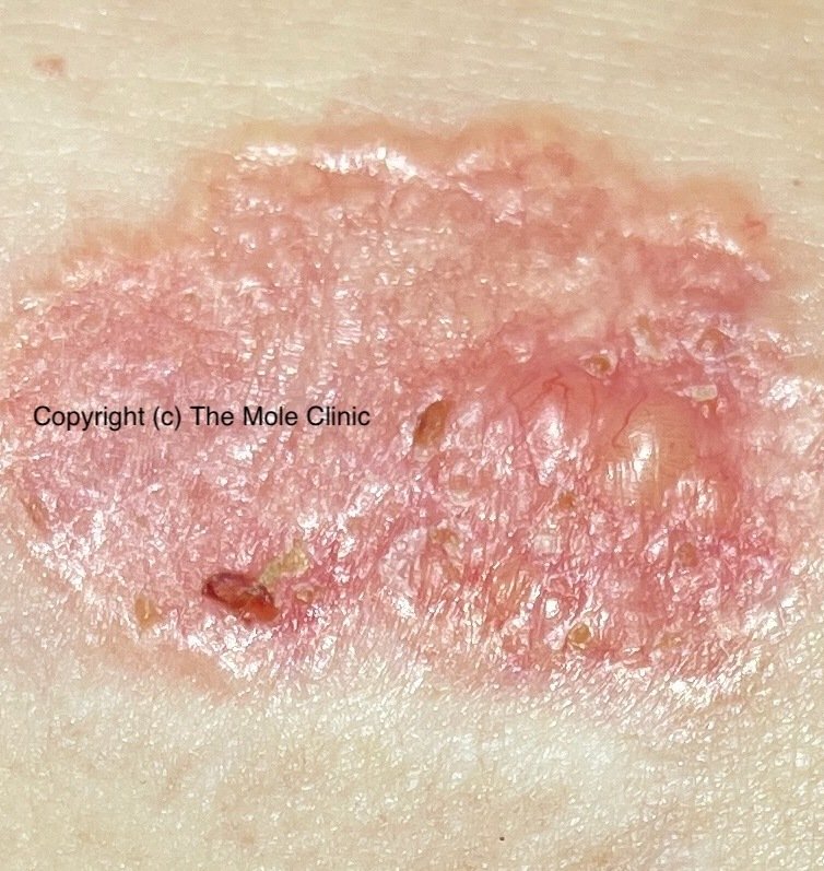 Diameter — example of a suspicious mole