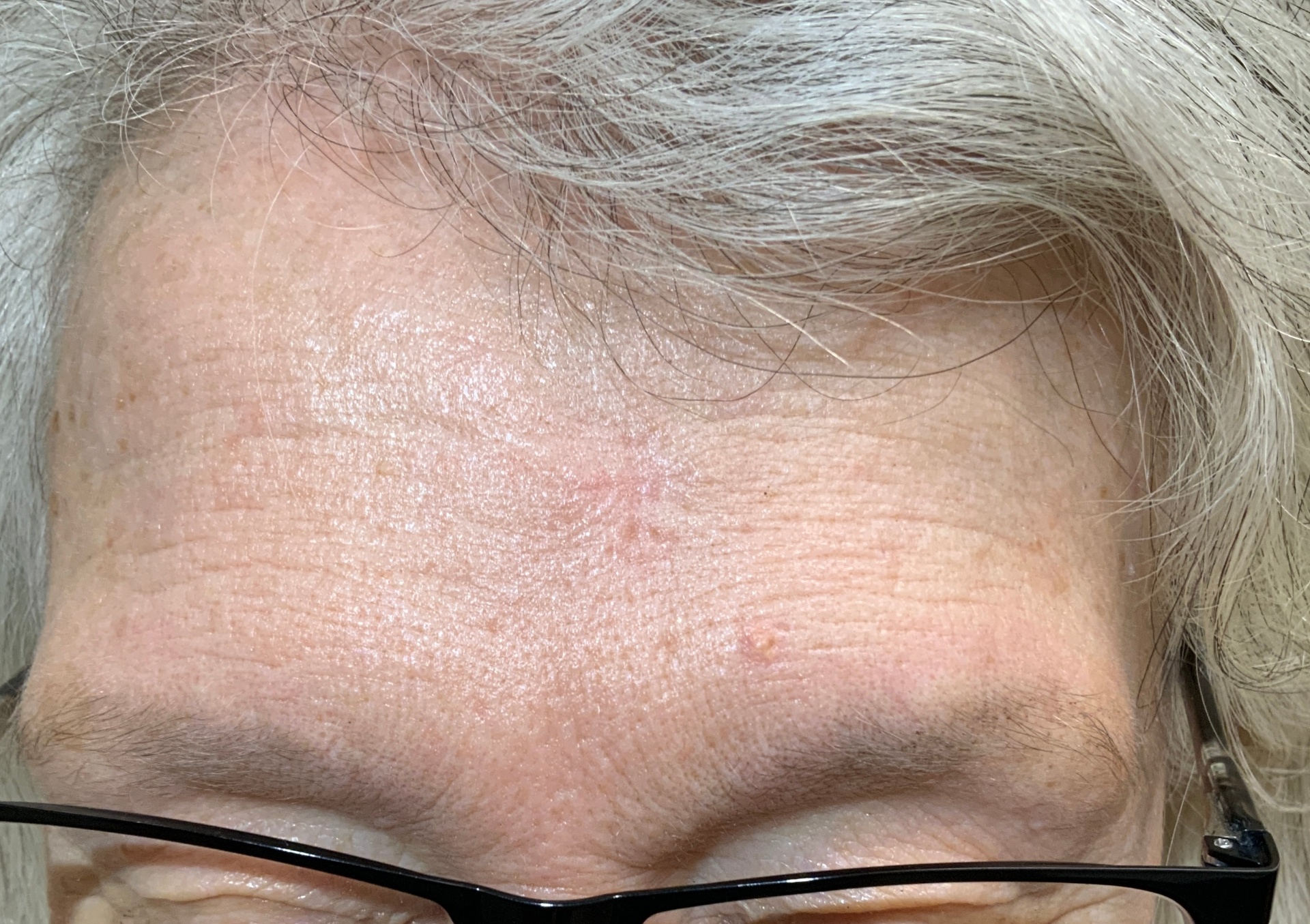 Expert Mole Removal — after