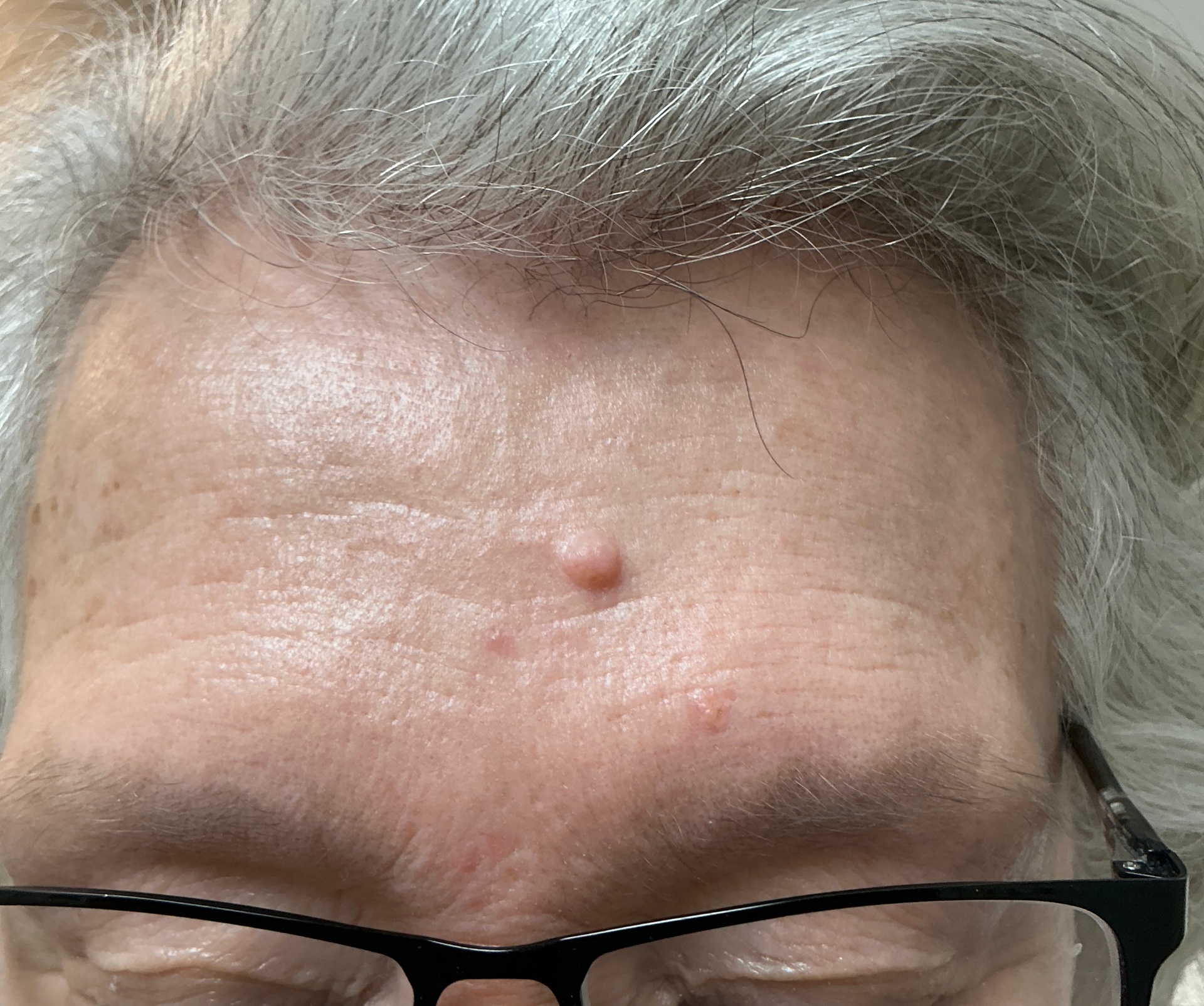 Expert Mole Removal — before