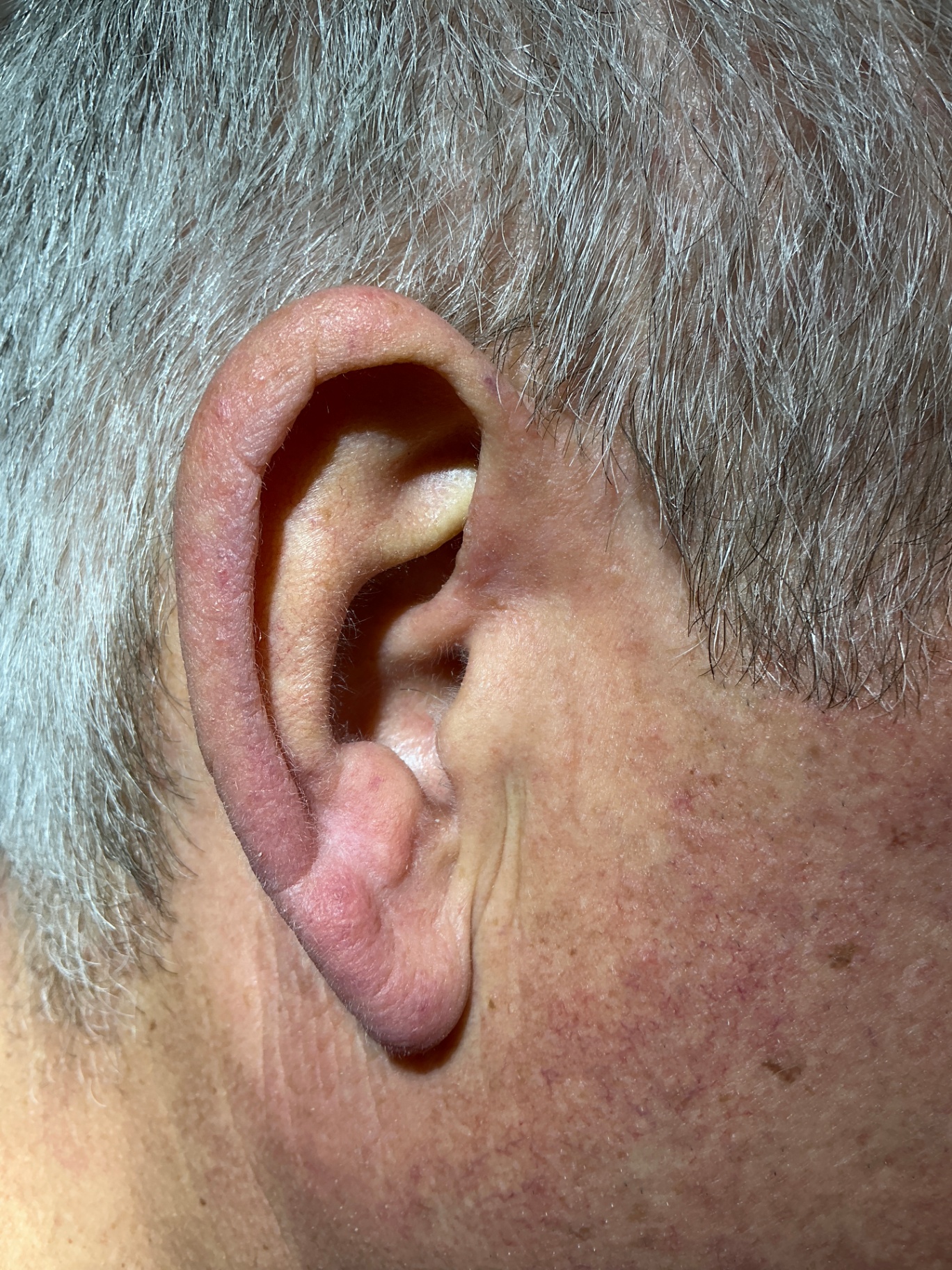 Seborrheic Keratosis & Sunspot Removal — After — 2 months after procedure