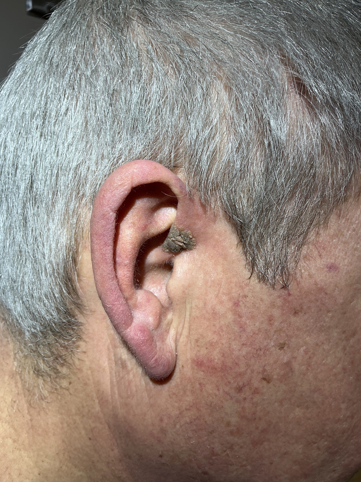 Seborrheic Keratosis & Sunspot Removal — Before