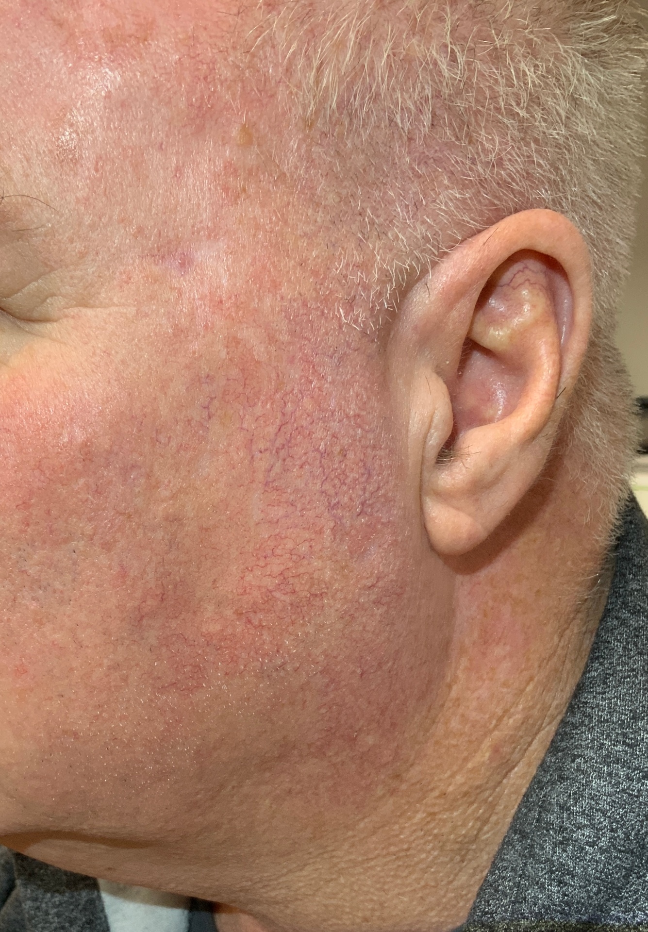 Spider Vein & Hemangioma Removal — 5 months after procedure