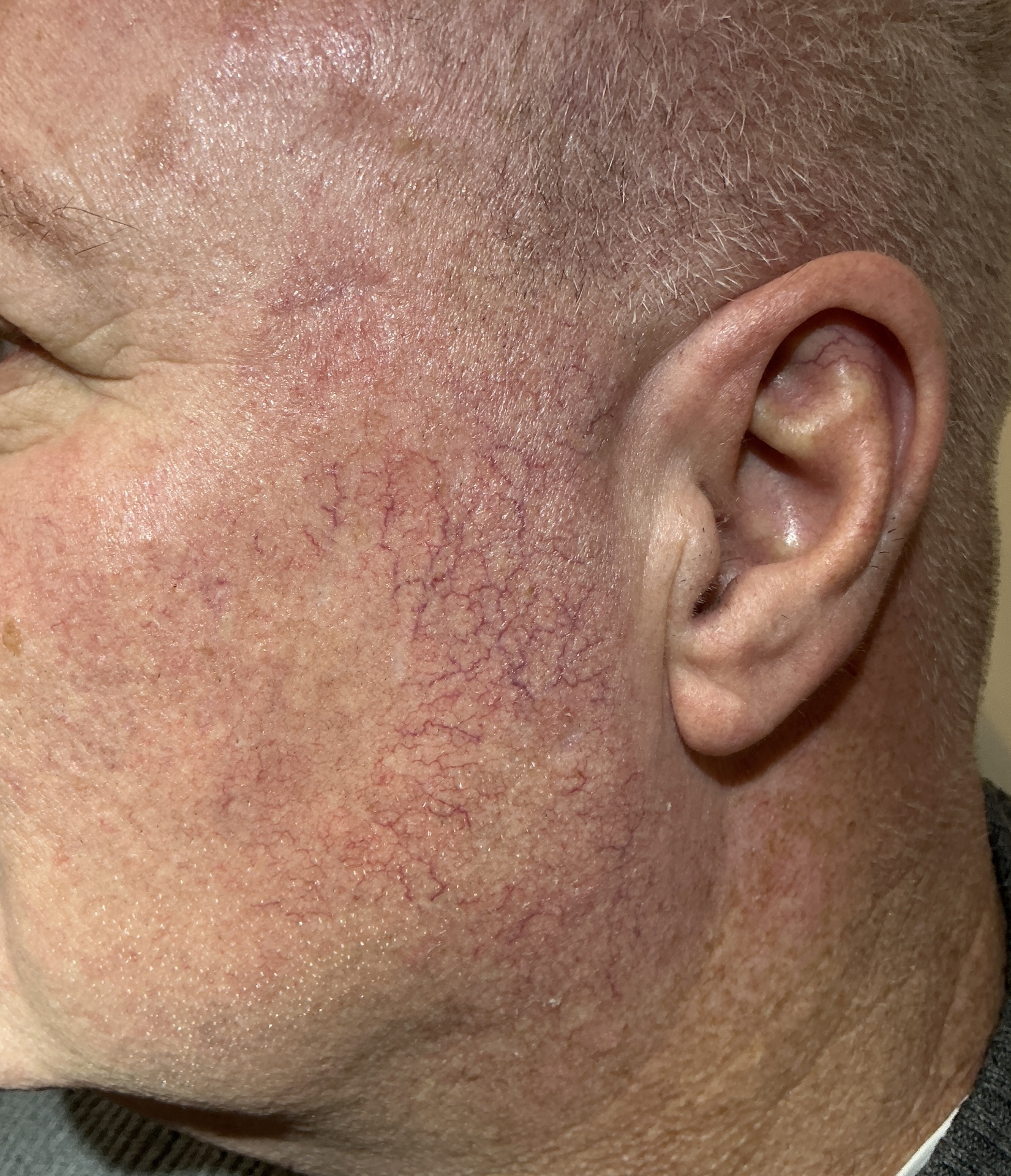 Spider Vein & Hemangioma Removal — Baseline