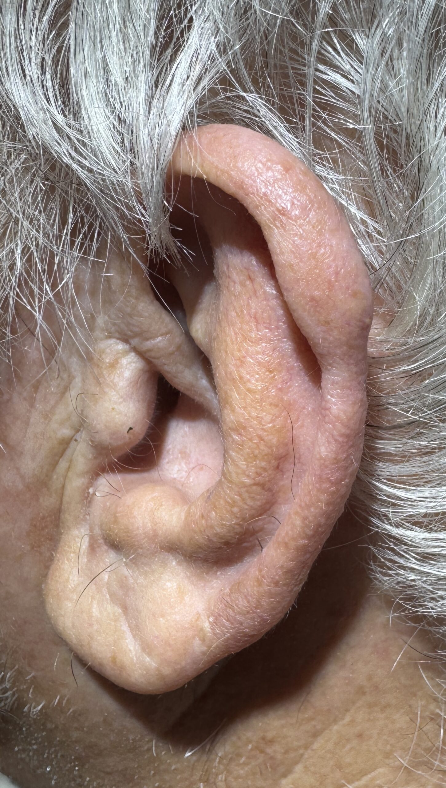 Expert Mole Removal — after