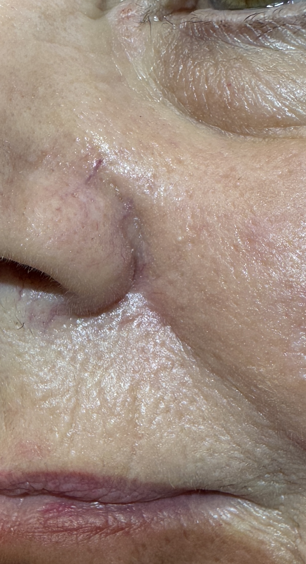 Expert Mole Removal — after