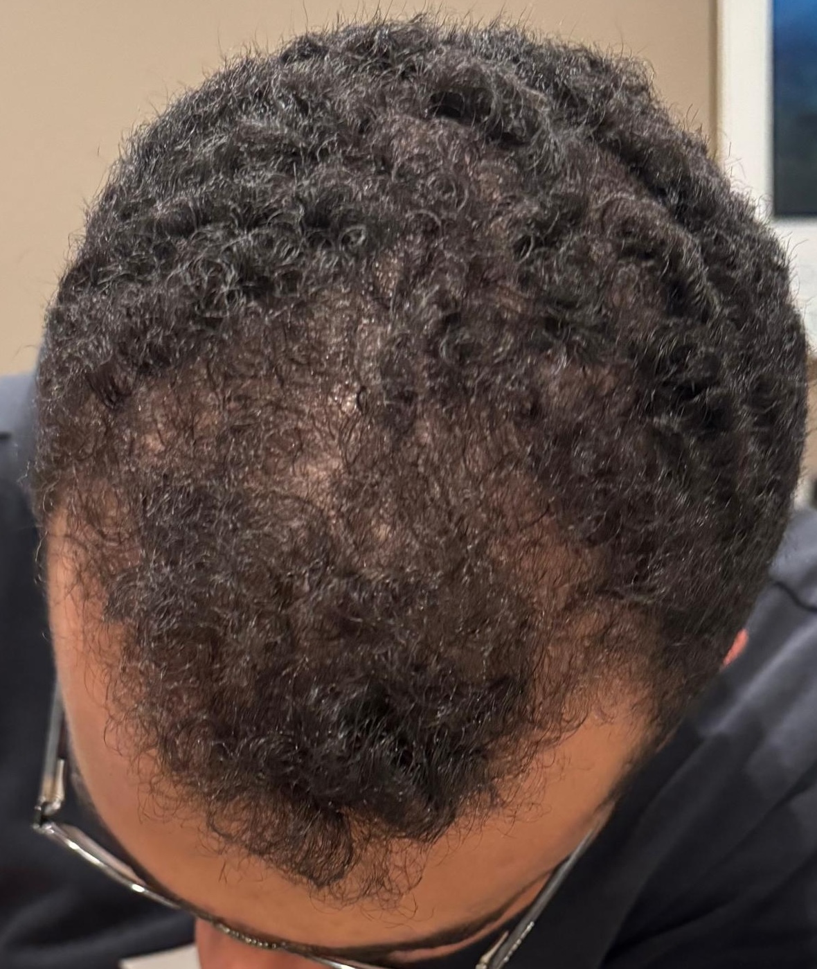 Platelet-Rich Plasma (PRP) — 8 months after 2 treatments