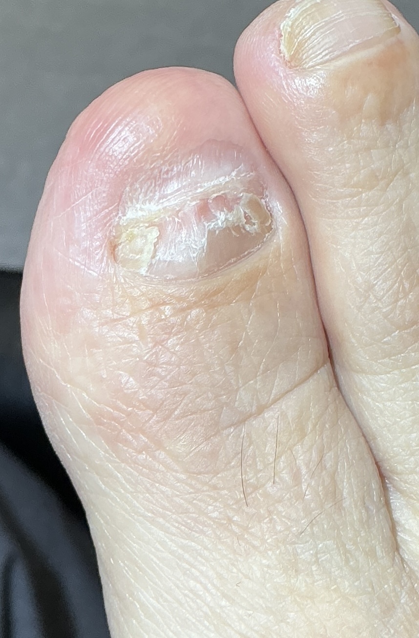 3 months after removal