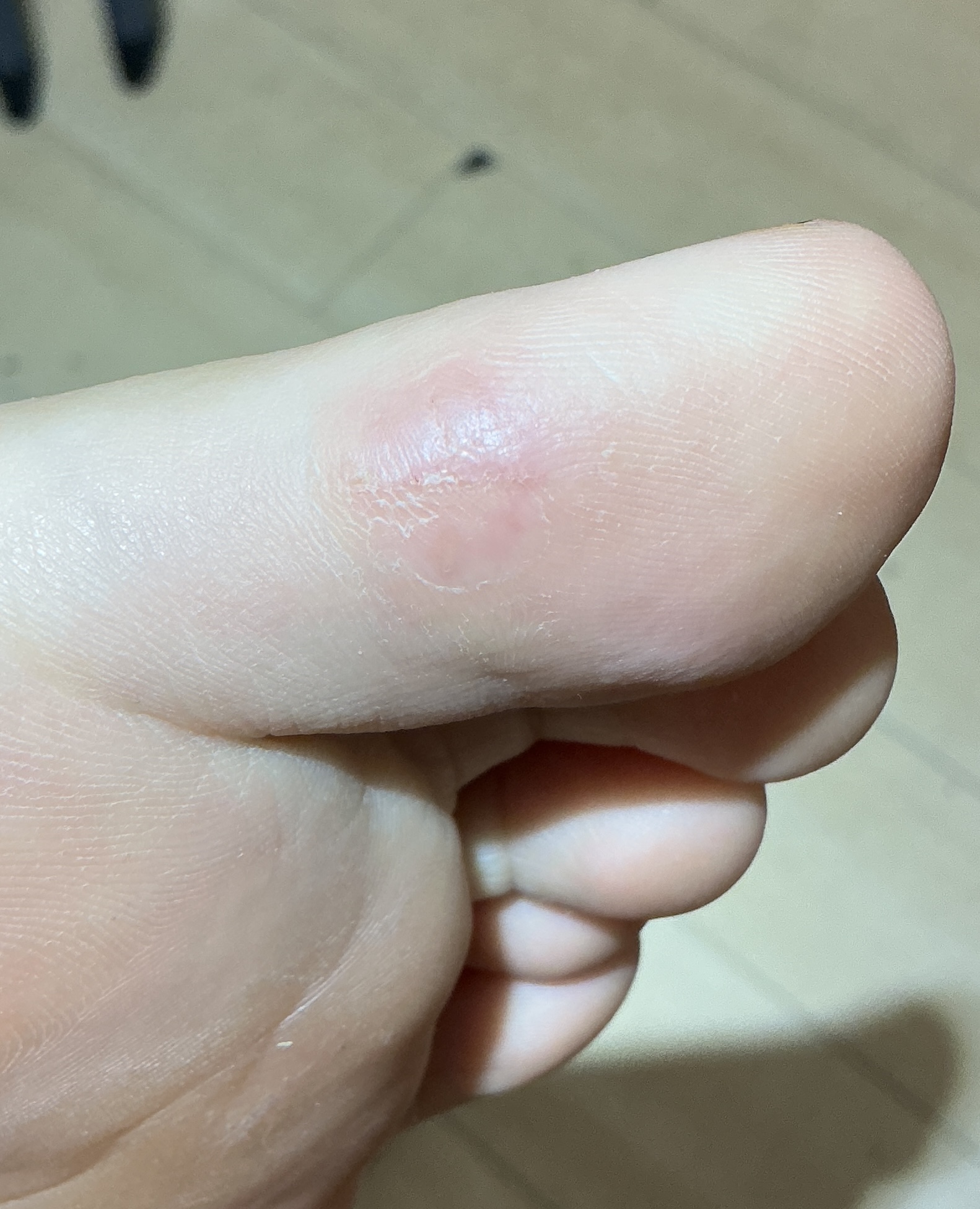 6 weeks after surgical removal