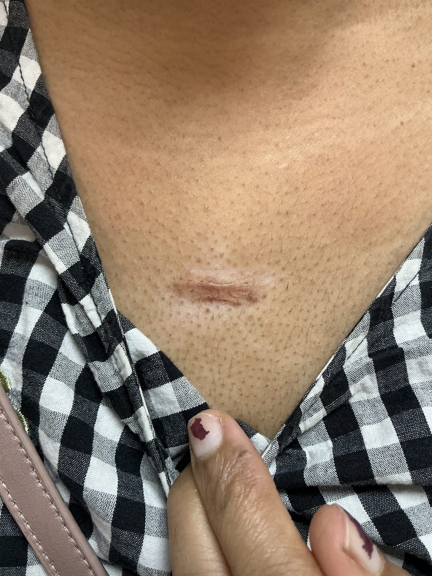 7 months after intralesional steroid injection (Type 5 skin)