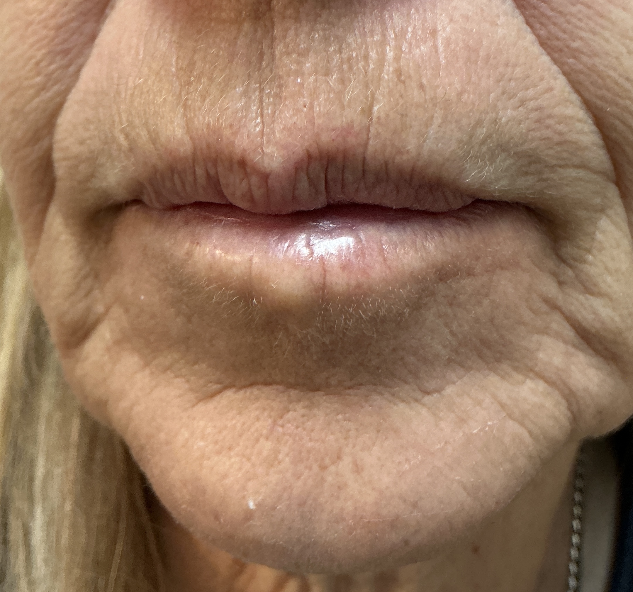 4 months after surgical removal