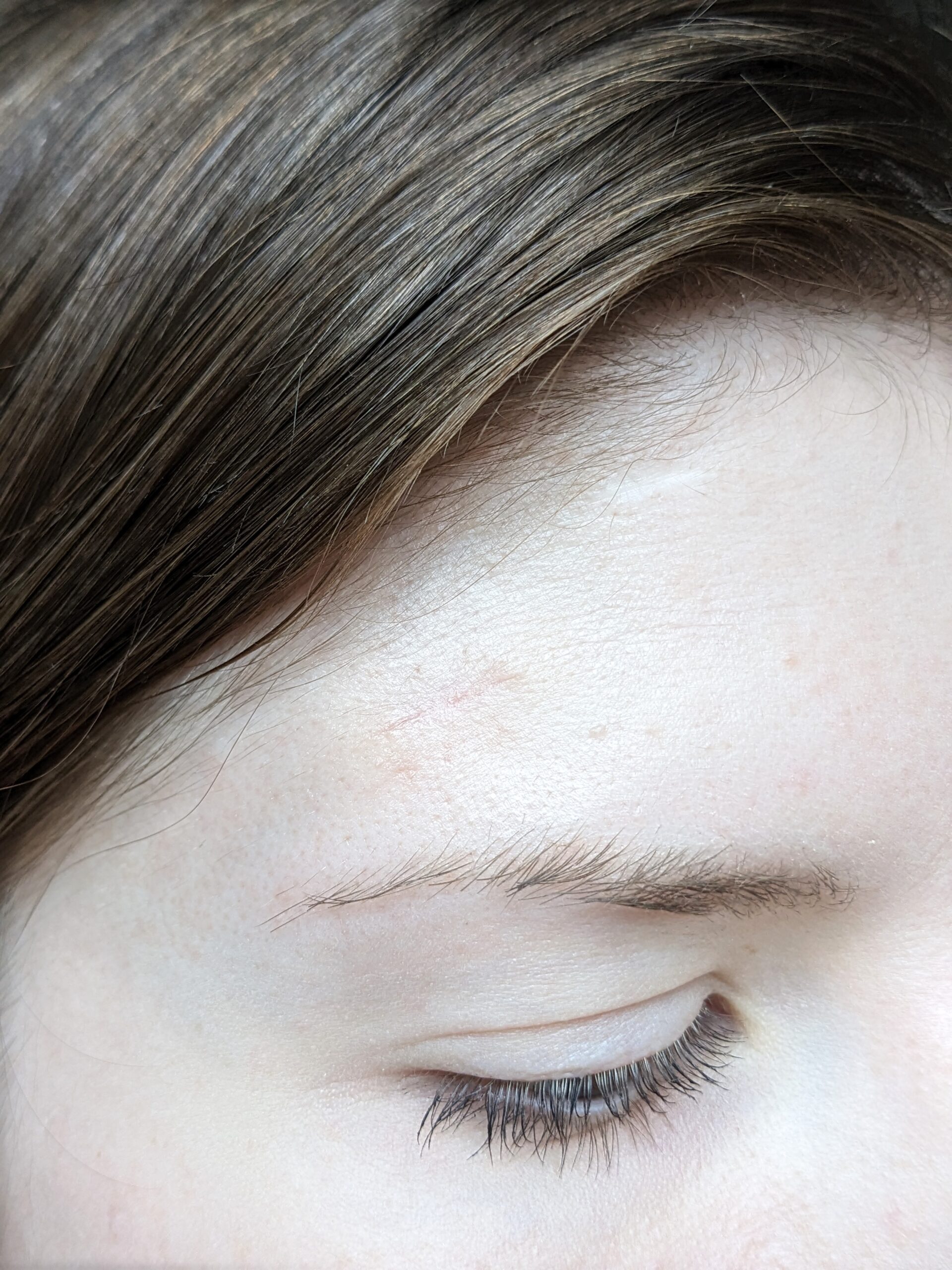 Expert Mole Removal — after