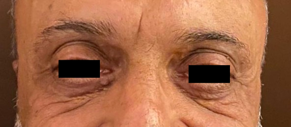 1 year post surgery