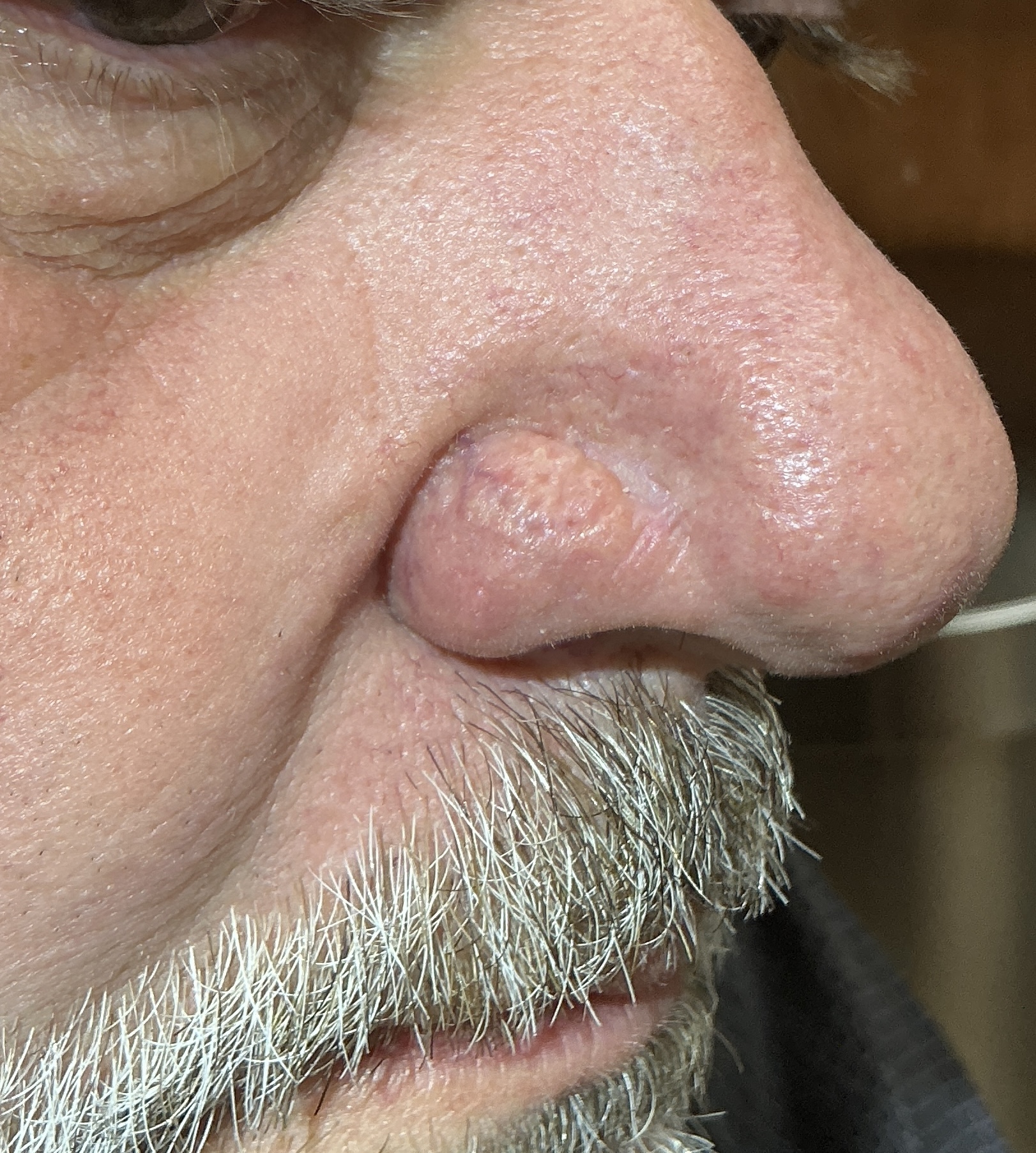 Expert Mole Removal — 12 weeks post procedure