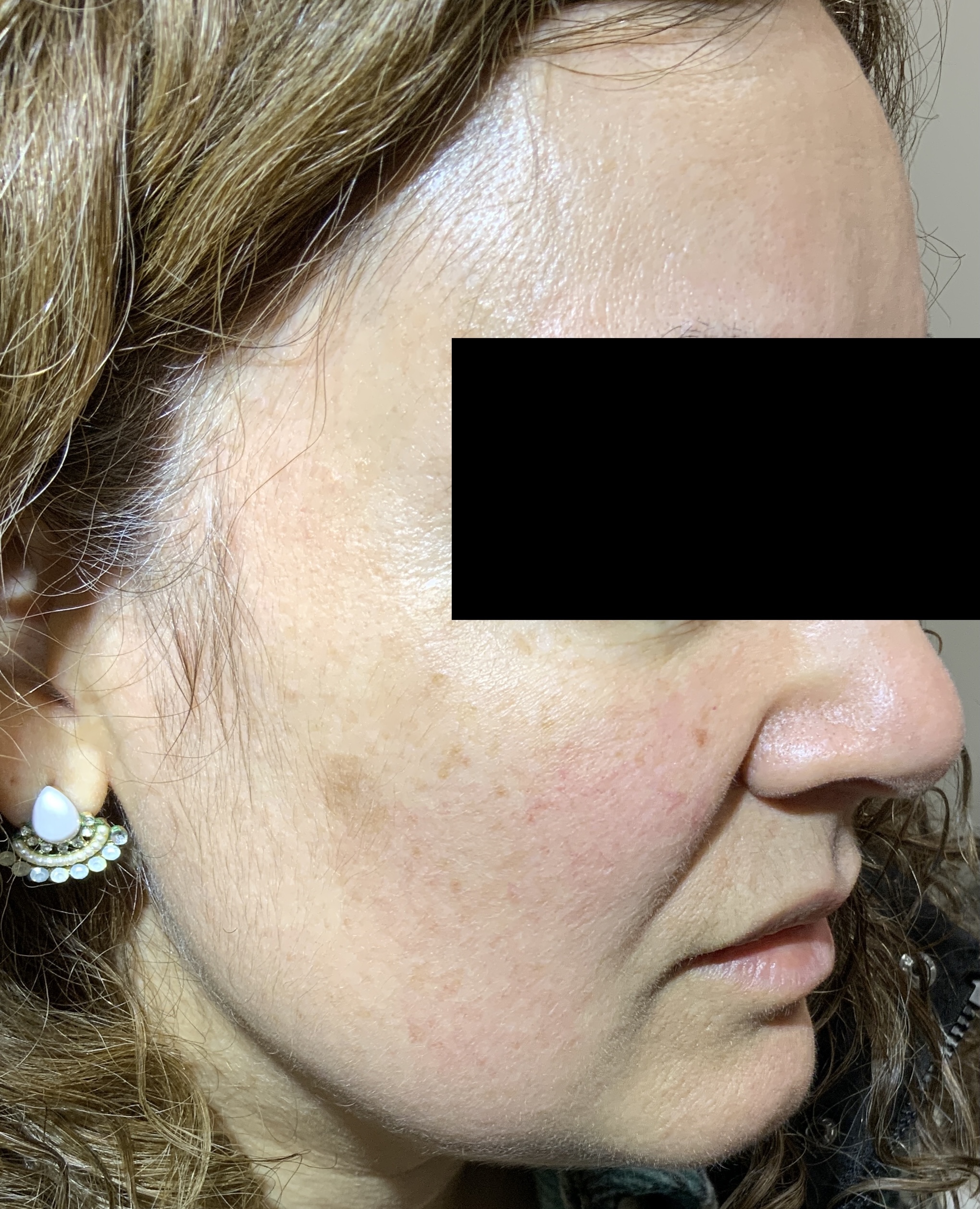 Seborrheic Keratosis & Sunspot Removal — After