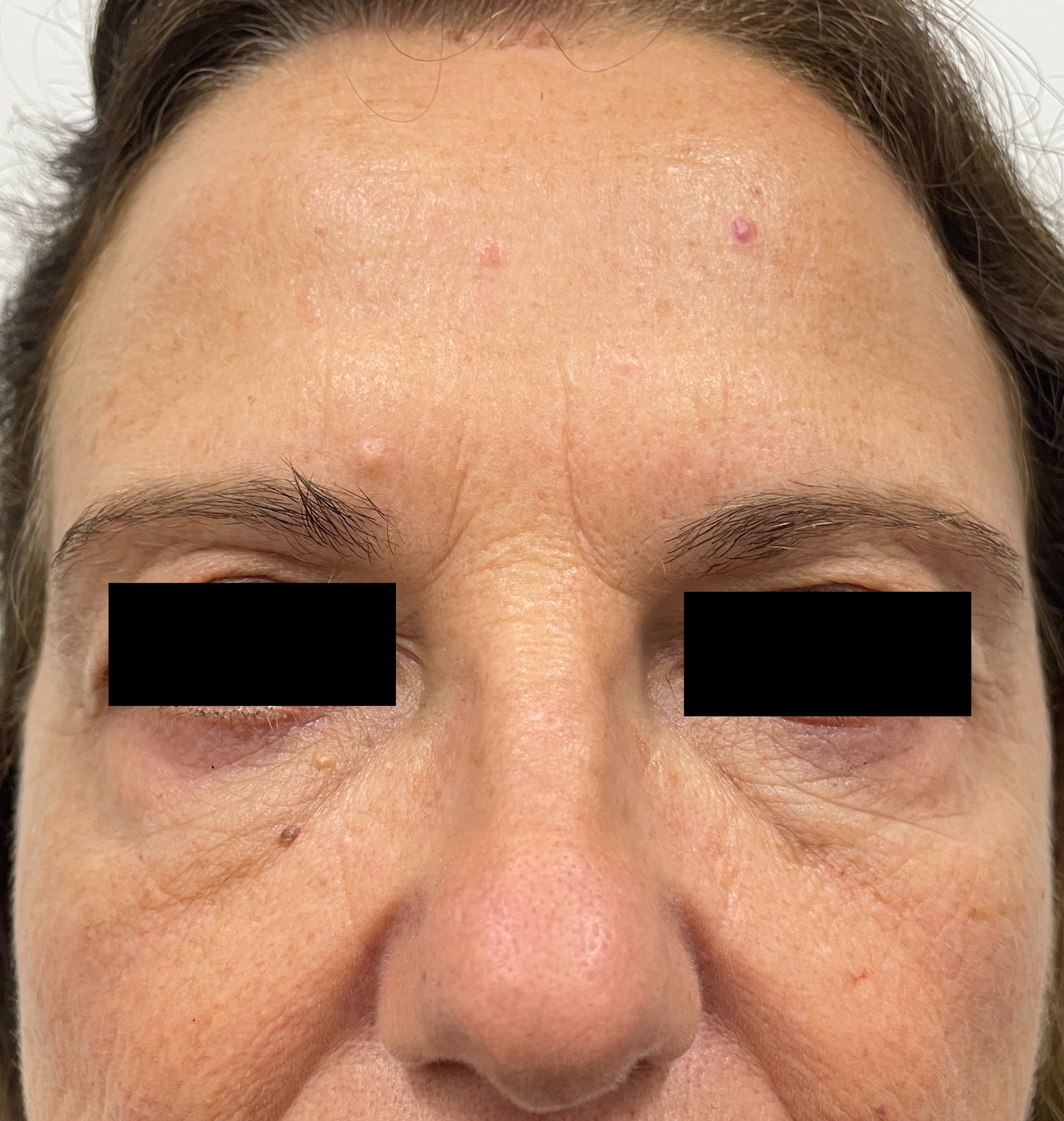 Botox & Dermal Fillers — Two weeks after