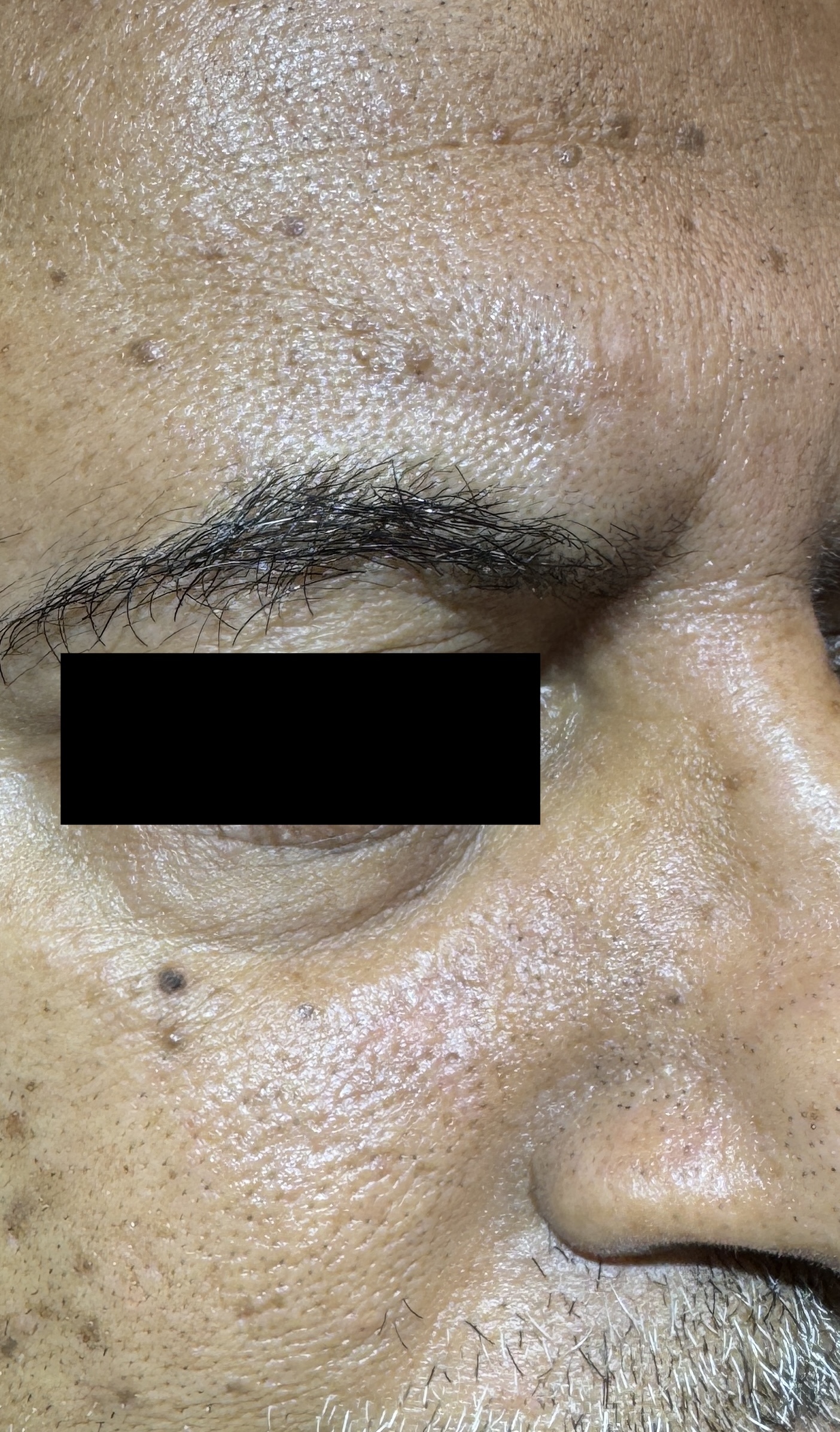 Seborrheic Keratosis & Sunspot Removal — After