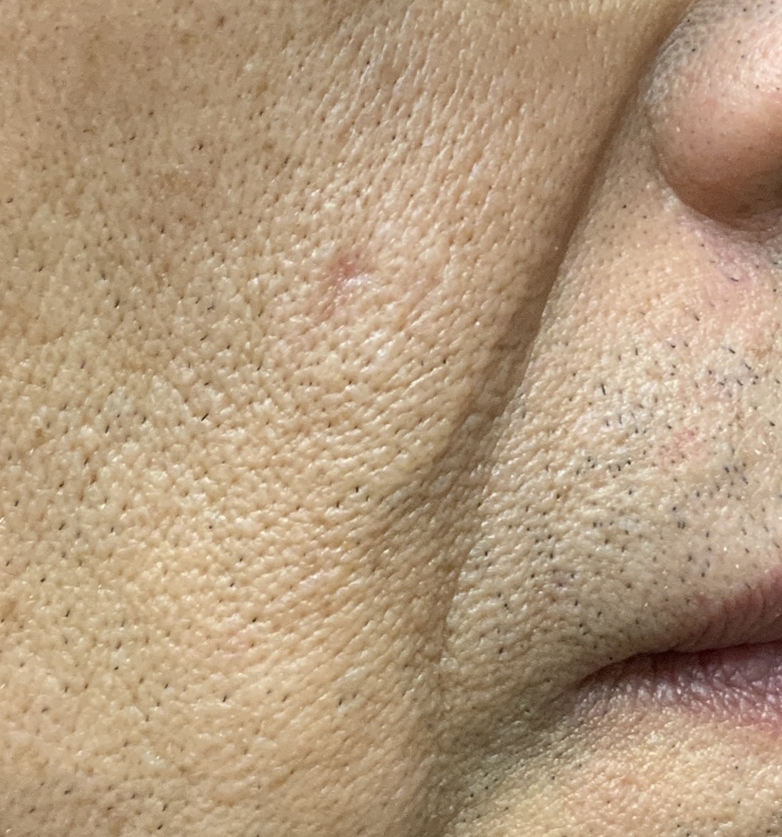 Expert Mole Removal — 8 weeks after