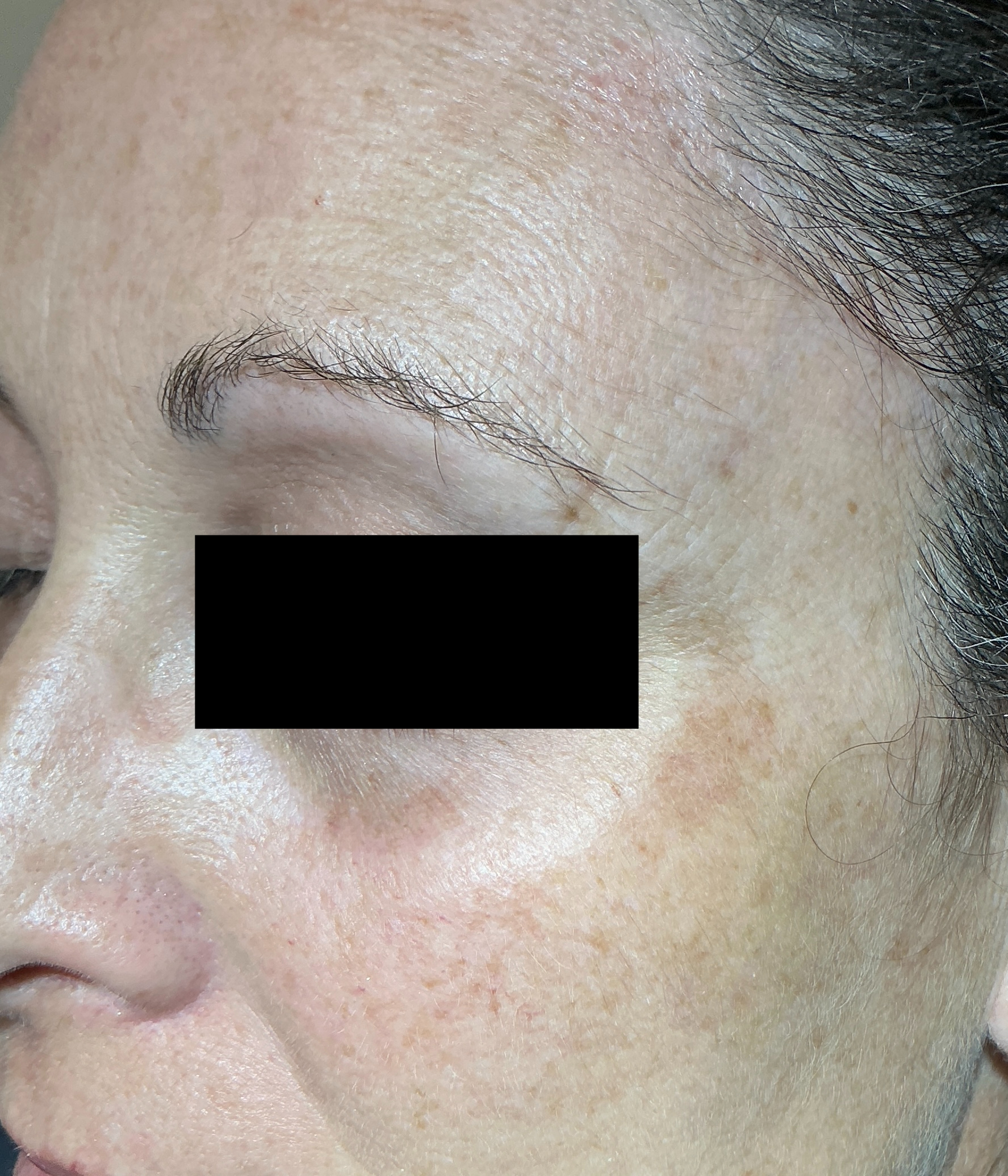 Seborrheic Keratosis & Sunspot Removal — 4 months after sunspots removal