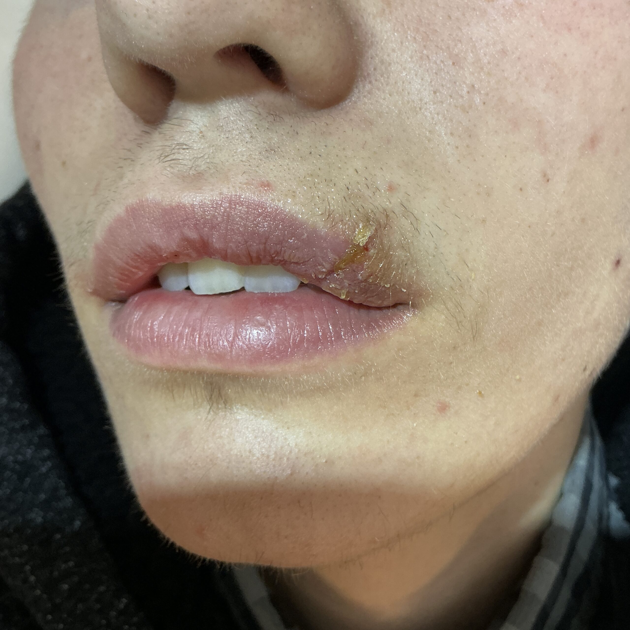 Expert Mole Removal — 7 days after