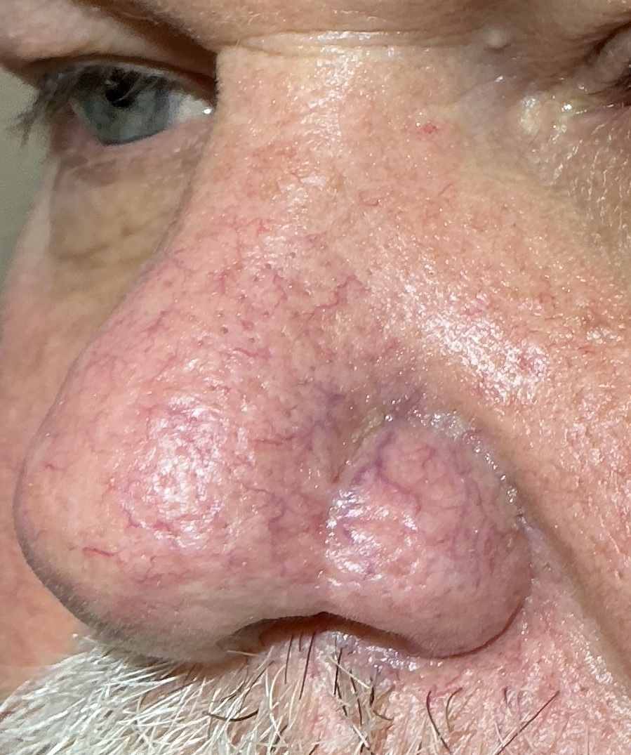Expert Mole Removal — 6 weeks after basal cell skin cancer removal