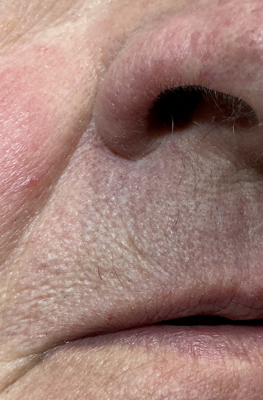 Expert Mole Removal — 6 months after removal