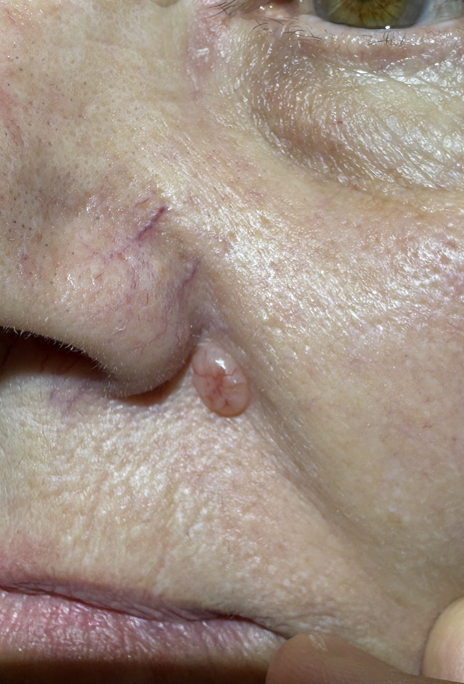 Expert Mole Removal — before