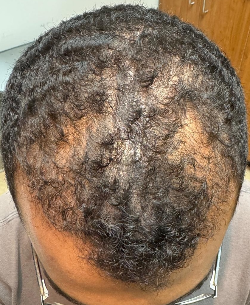 Platelet-Rich Plasma (PRP) — Baseline