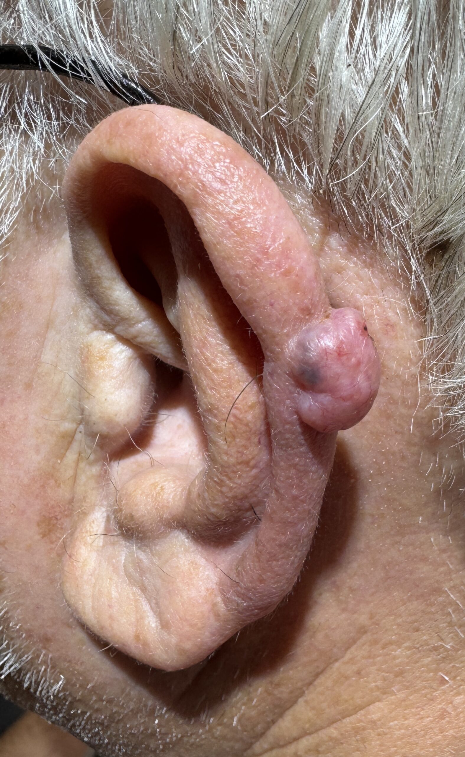Expert Mole Removal — before