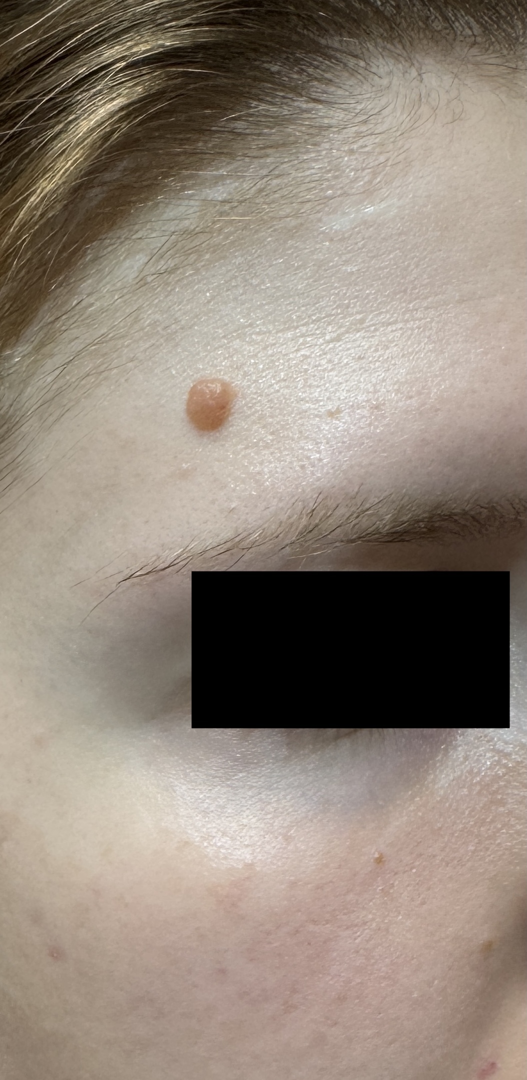 Expert Mole Removal — before